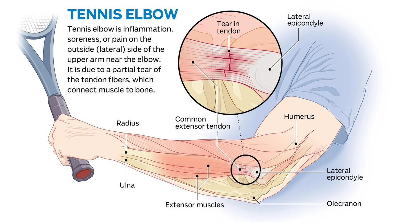 Can you get a tennis elbow from playing the piano?
